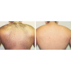 MENS LASER HAIR REMOVAL HOUNSLOW