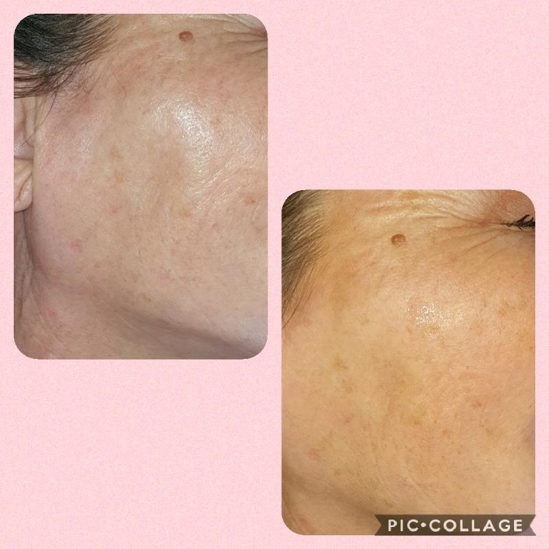 Gel polish/dermaplane